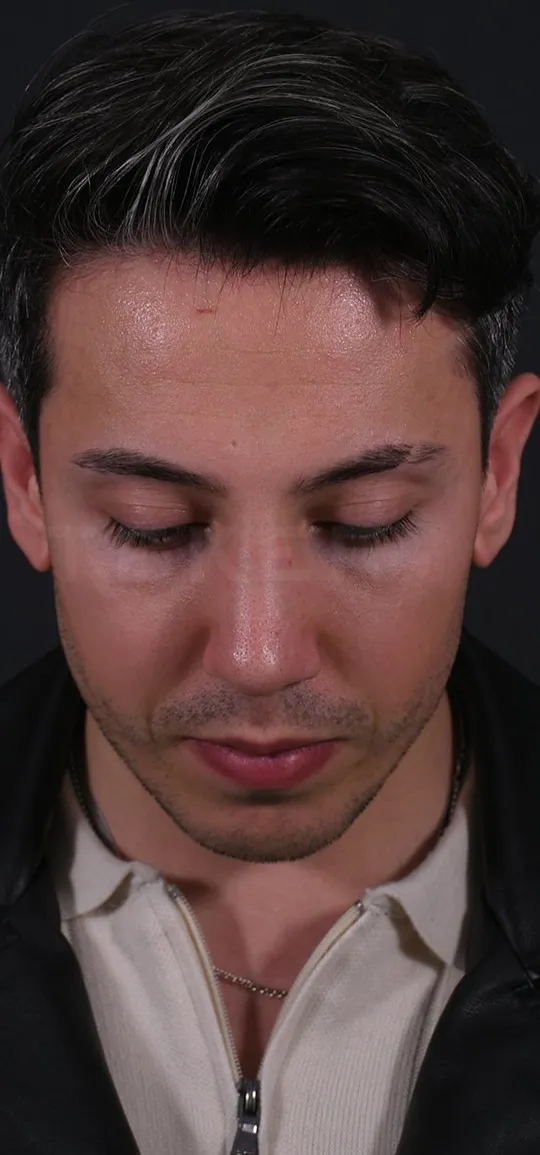 After: Rhinoplasty with a chin implant, Set 1, from above (1) — Photographed in the second year after the operation