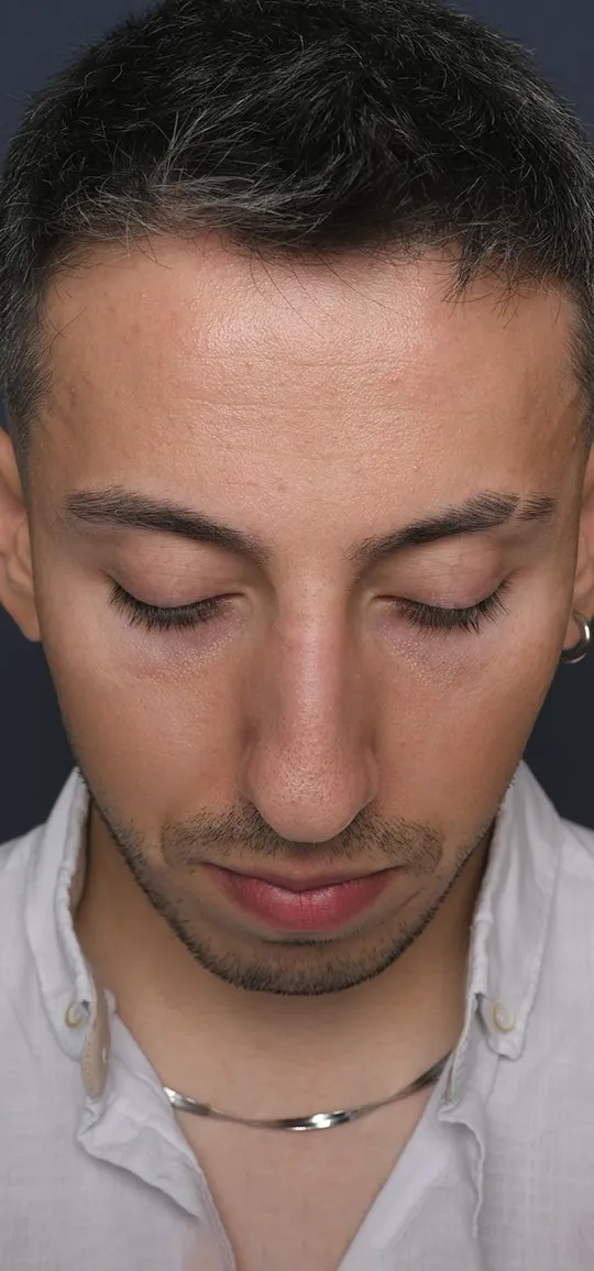 Before: Rhinoplasty with a chin implant, Set 1, from above (1)