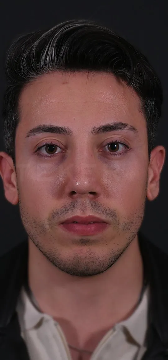 After: Rhinoplasty with a chin implant, Set 1, front (2) — Photographed in the second year after the operation