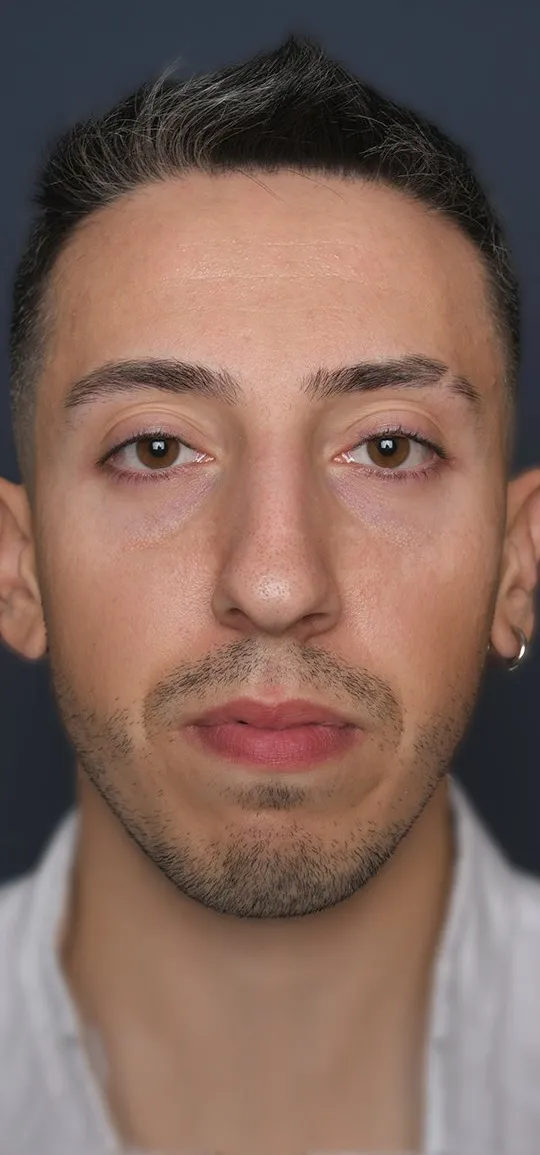Before: Rhinoplasty with a chin implant, Set 1, front (2)