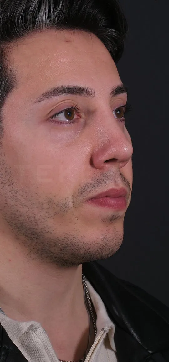 After: Rhinoplasty with a chin implant, Set 1, three-quarter view (3) — Photographed in the second year after the operation
