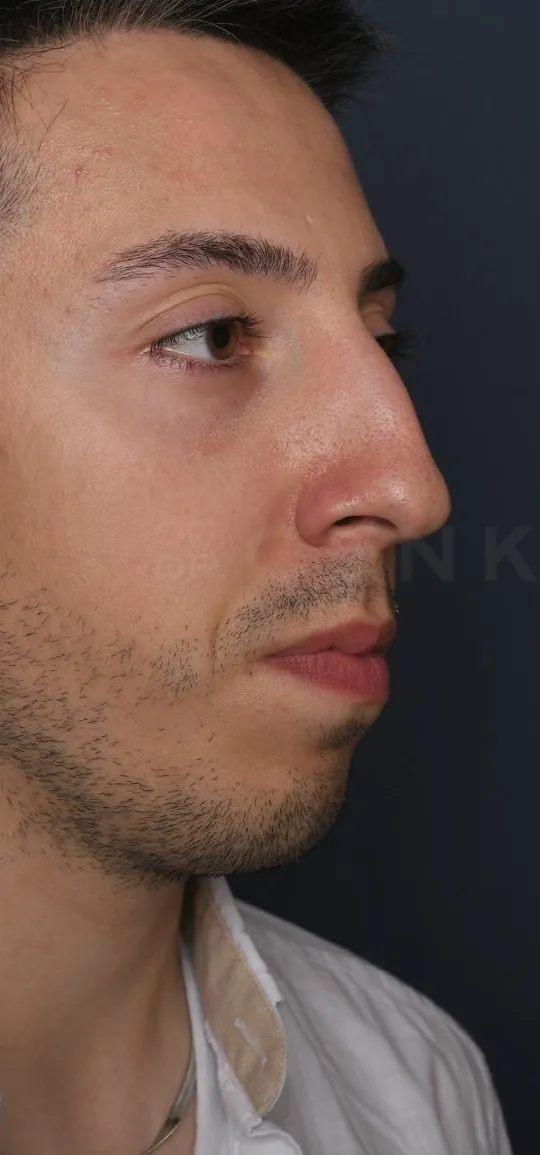 Before: Rhinoplasty with a chin implant, Set 1, three-quarter view (3)
