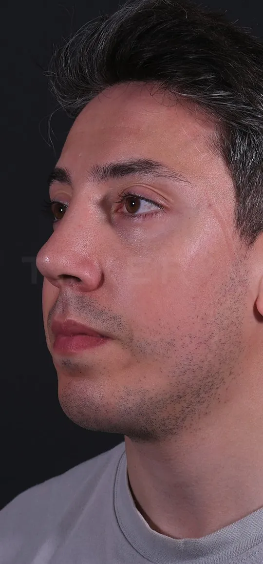 After: Rhinoplasty with a chin implant, Set 1, three-quarter view (4) — Photographed in the second year after the operation