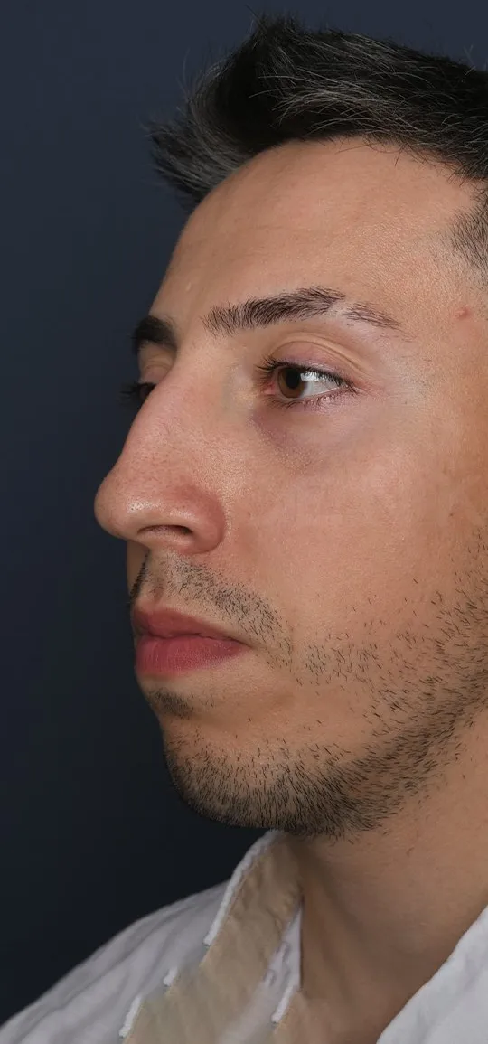 Before: Rhinoplasty with a chin implant, Set 1, three-quarter view (4)