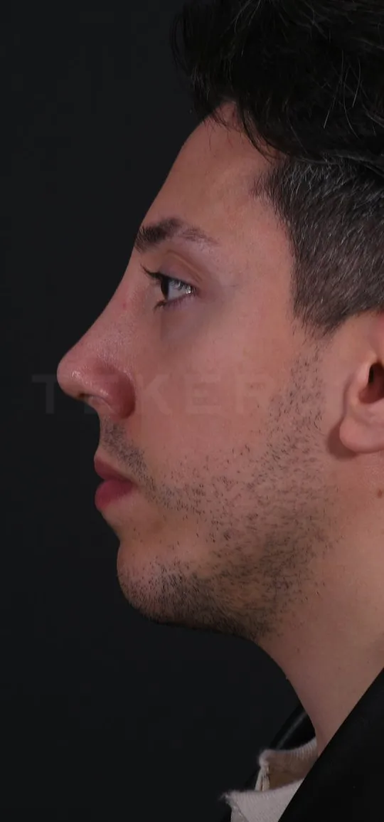 After: Rhinoplasty with a chin implant, Set 1, profile (5) — Photographed in the second year after the operation
