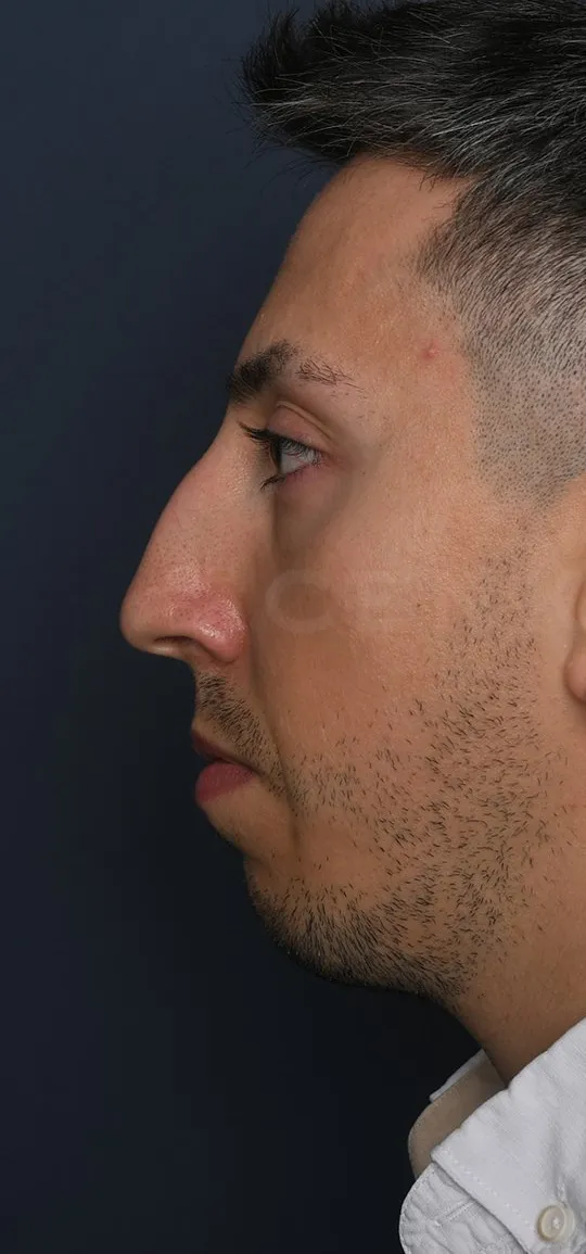 Before: Rhinoplasty with a chin implant, Set 1, profile (5)