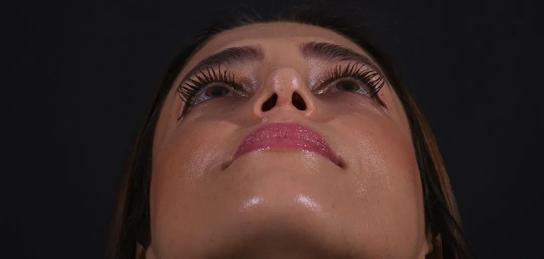 After: Rhinoplasty, Set 2, from below (1) — Photographed one month after the operation