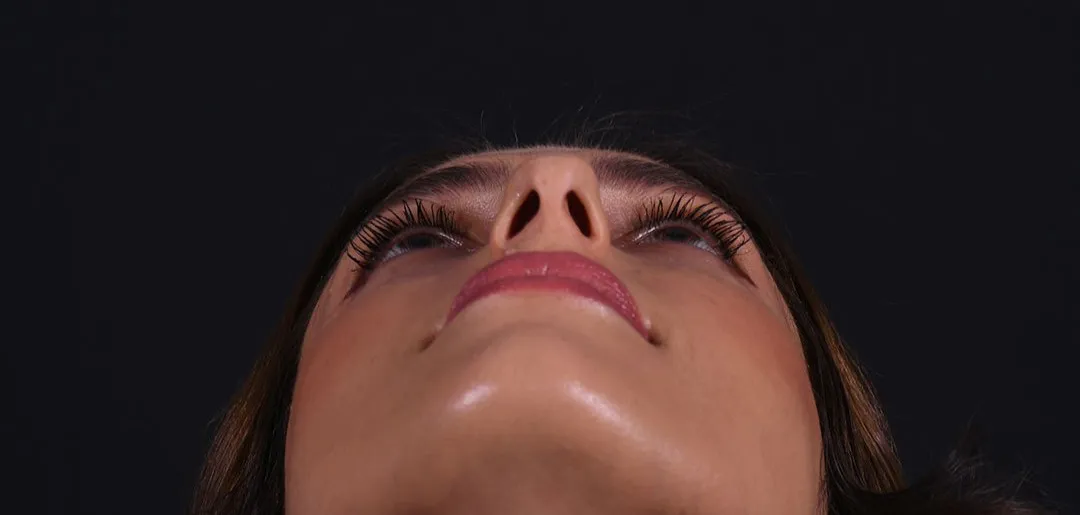 Before: Rhinoplasty, Set 2, from below (1)