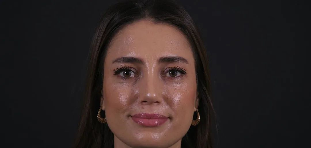 After: Rhinoplasty, Set 2, front (3) — Photographed one month after the operation