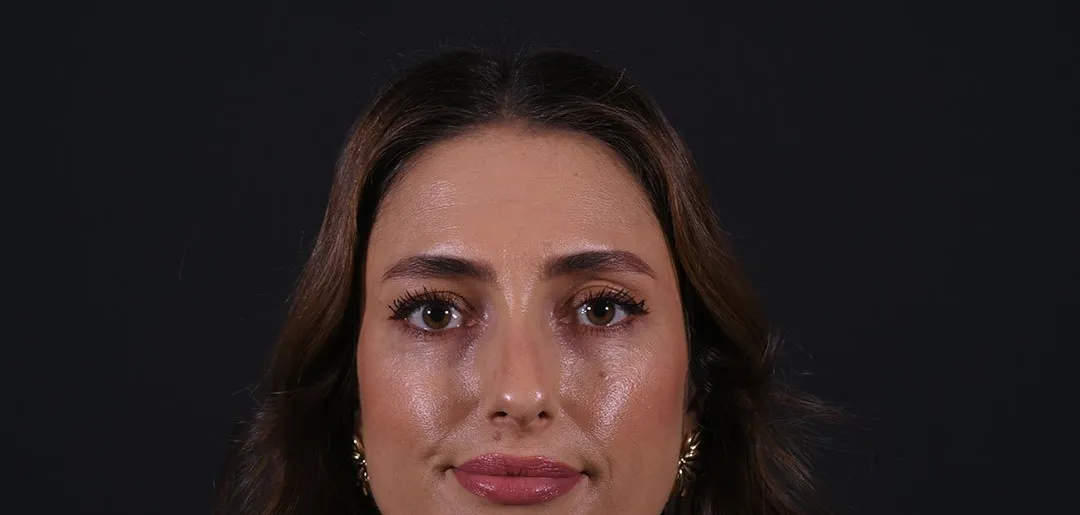 Before: Rhinoplasty, Set 2, front (3)