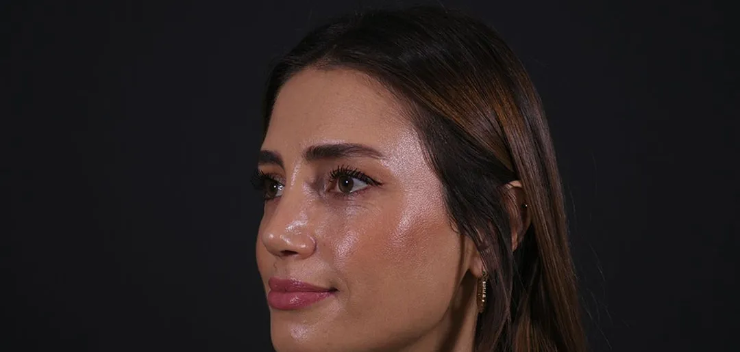After: Rhinoplasty, Set 2, three-quarter view (4) — Photographed one month after the operation
