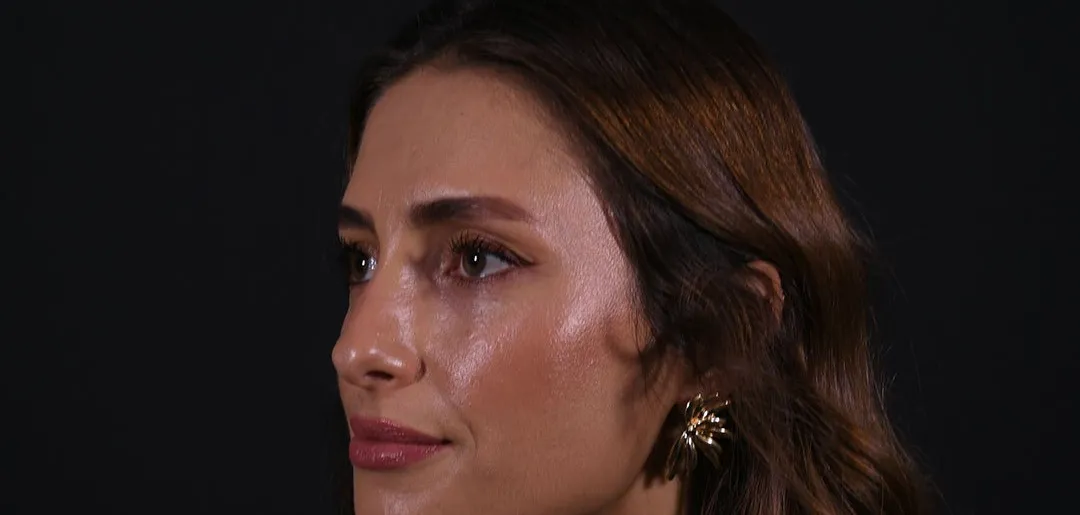 Before: Rhinoplasty, Set 2, three-quarter view (4)
