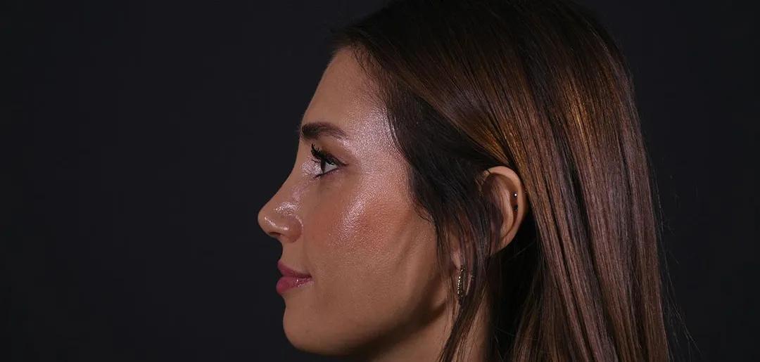 After: Rhinoplasty, Set 2, profile (5) — Photographed one month after the operation