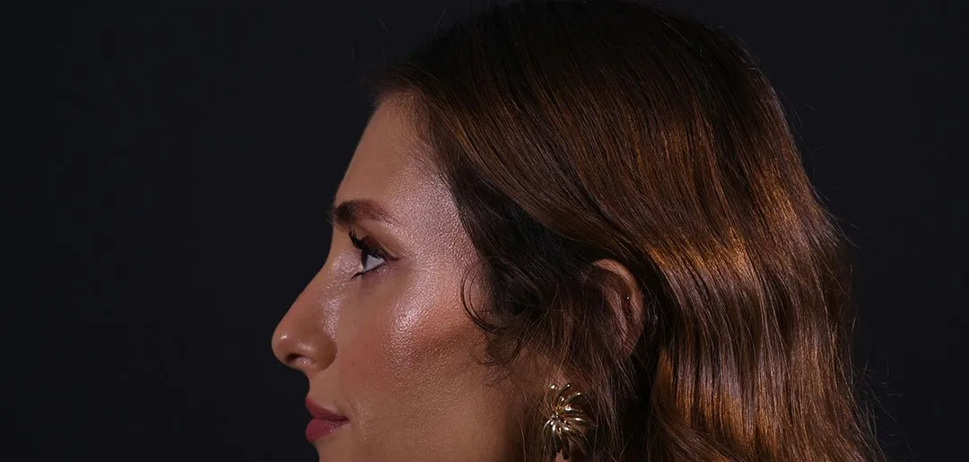 Before: Rhinoplasty, Set 2, profile (5)
