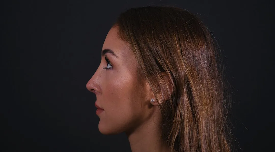 After: Rhinoplasty, Set 3, profile (1) — Photographed eight months after the operation
