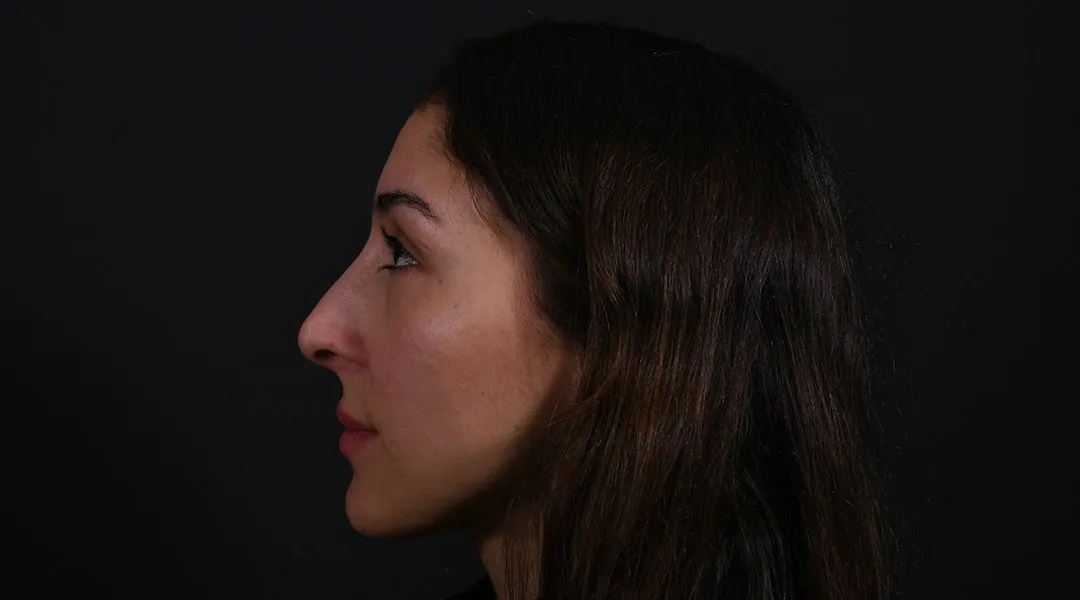 Before: Rhinoplasty, Set 3, profile (1)
