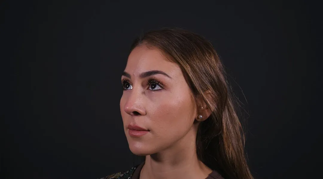 After: Rhinoplasty, Set 3, three-quarter view (2) — Photographed eight months after the operation