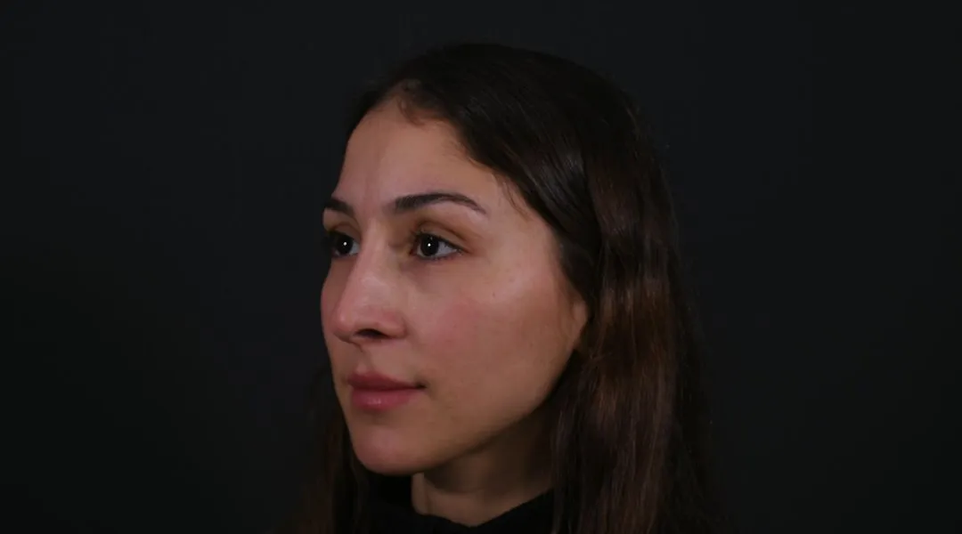 Before: Rhinoplasty, Set 3, three-quarter view (2)