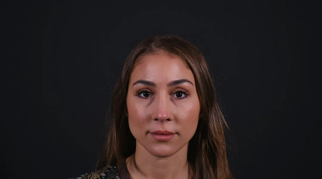 After: Rhinoplasty, Set 3, front (3) — Photographed eight months after the operation