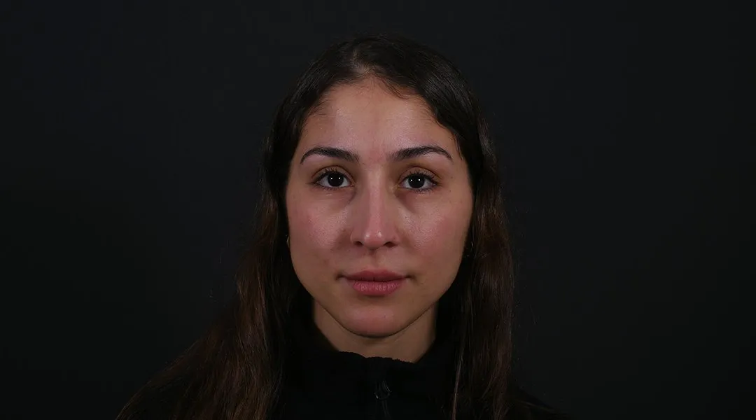 Before: Rhinoplasty, Set 3, front (3)