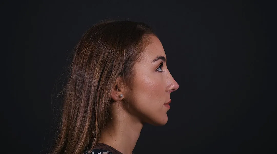 After: Rhinoplasty, Set 3, profile (4) — Photographed eight months after the operation