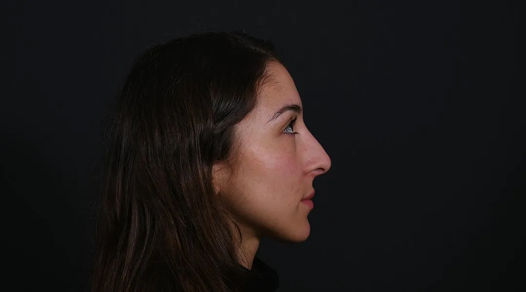 Before: Rhinoplasty, Set 3, profile (4)