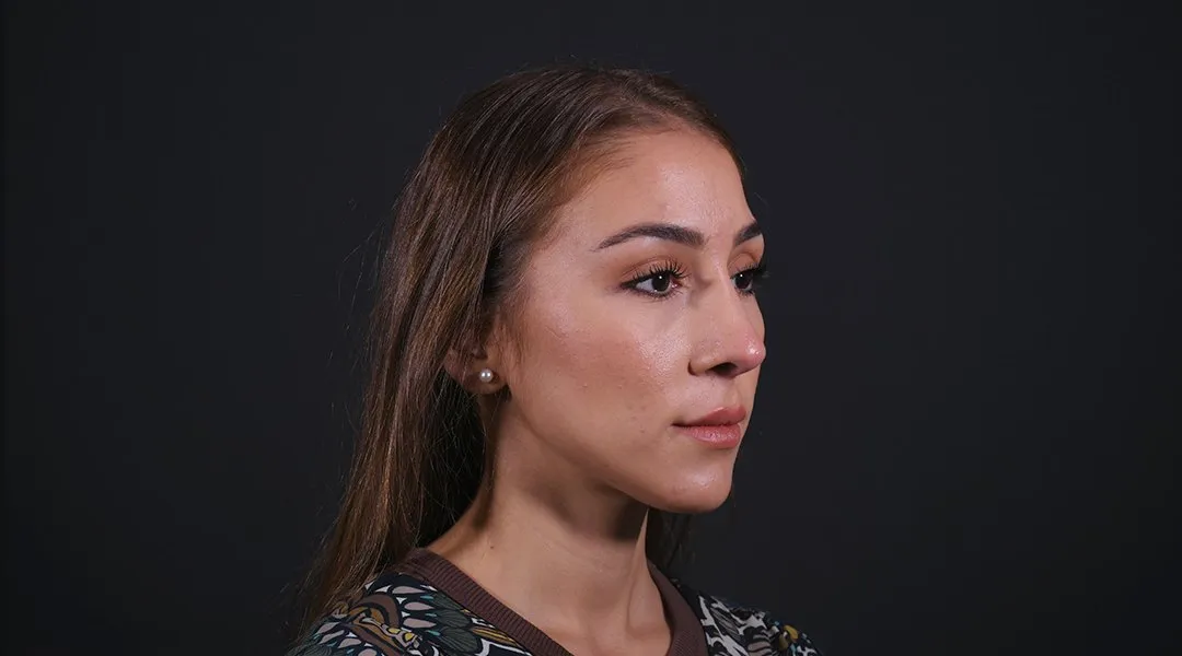 After: Rhinoplasty, Set 3, three-quarter view (5) — Photographed eight months after the operation
