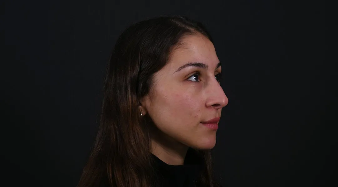 Before: Rhinoplasty, Set 3, three-quarter view (5)