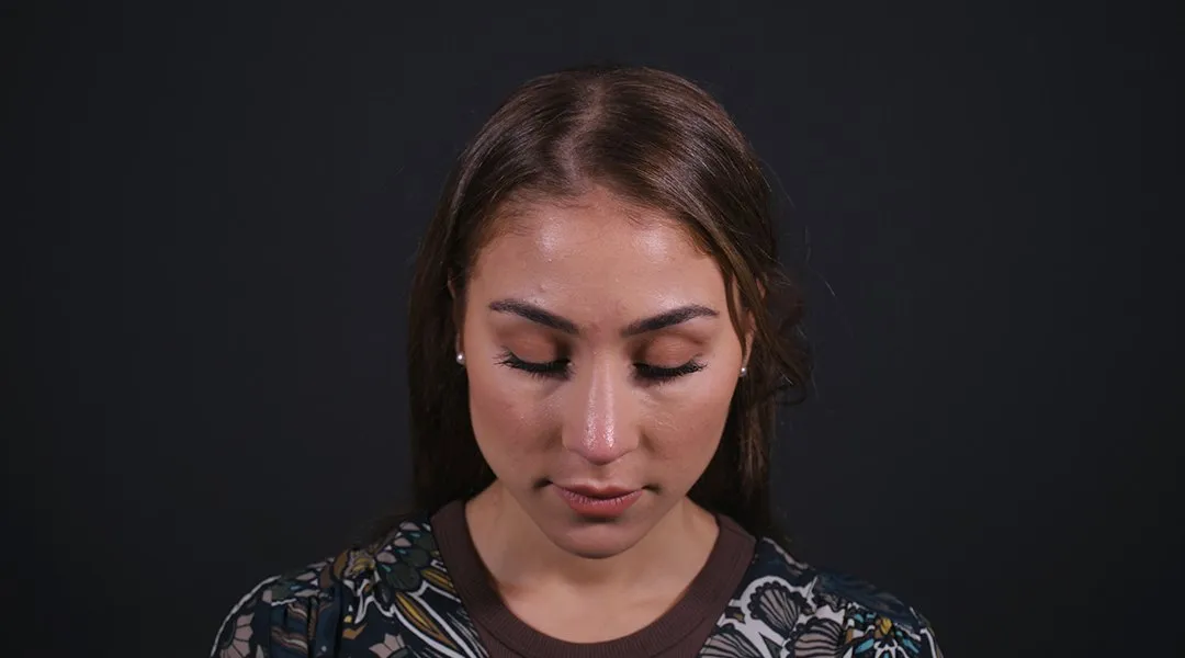 After: Rhinoplasty, Set 3, from above (6) — Photographed eight months after the operation