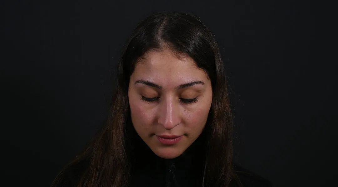 Before: Rhinoplasty, Set 3, from above (6)
