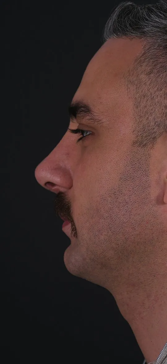 After: Rhinoplasty, Set 4, profile (1) — Photographed five months after the operation