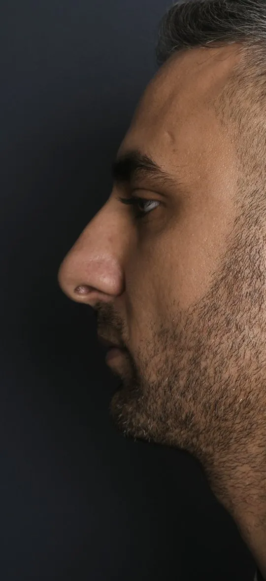 Before: Rhinoplasty, Set 4, profile (1)