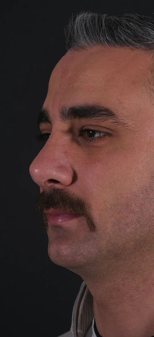 After: Rhinoplasty, Set 4, three-quarter view (2) — Photographed five months after the operation
