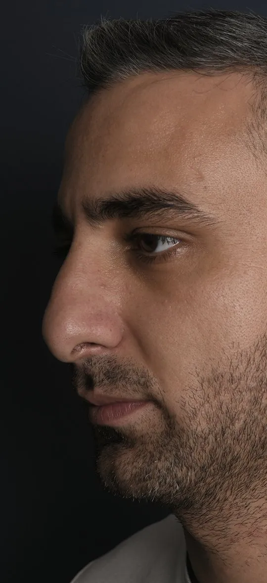 Before: Rhinoplasty, Set 4, three-quarter view (2)