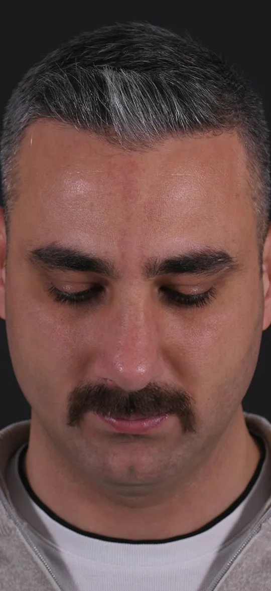 After: Rhinoplasty, Set 4, from above (3) — Photographed five months after the operation