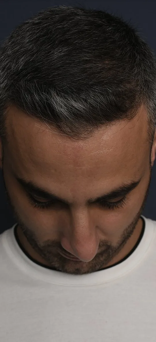 Before: Rhinoplasty, Set 4, from above (3)